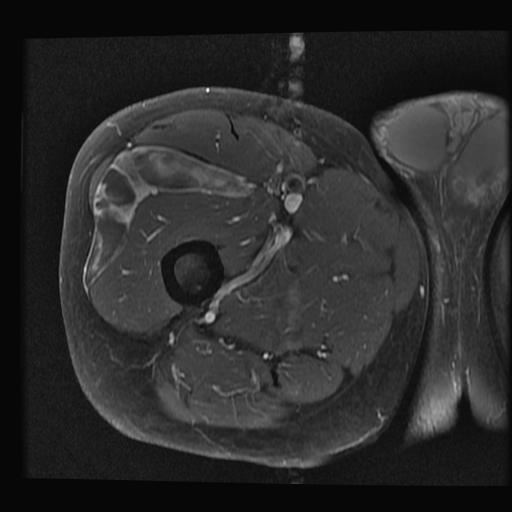 Sarcoma Thigh Axial